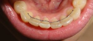 Dental braces in visakhaptnam | Suraksha Dental Park