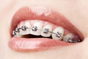 dental braces in Vizag