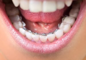 dental braces in Vizag | Suraksha Dental Park