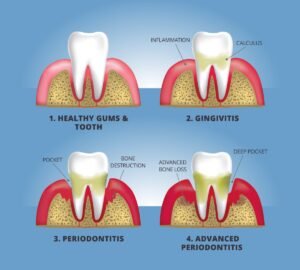 Stages of gum disease showing healthy gums, gingivitis, periodontitis, and advanced periodontitis with bone loss and deep pockets.