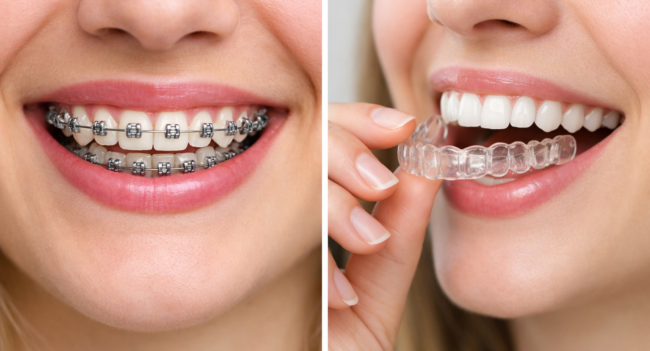 lose-up comparison of teeth with metal braces and clear aligners showing orthodontic treatment options.