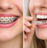 lose-up comparison of teeth with metal braces and clear aligners showing orthodontic treatment options.