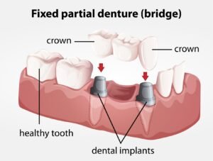 Fixed partial denture dental bridge supported by dental implants and crowns replacing missing teeth.