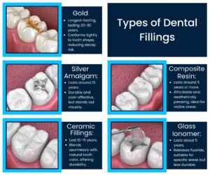 Different dental filling materials used by dentists for treating tooth decay and cavities.