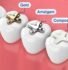 three molar teeth with different filling materials labeled gold, amalgam (silver), and composite (white).
