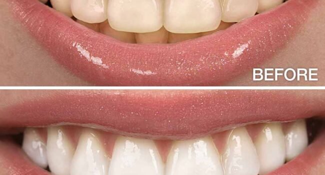 Before and after comparison of teeth whitening treatment showing noticeable improvement in tooth color and brightness.