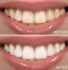 Before and after comparison of teeth whitening treatment showing noticeable improvement in tooth color and brightness.