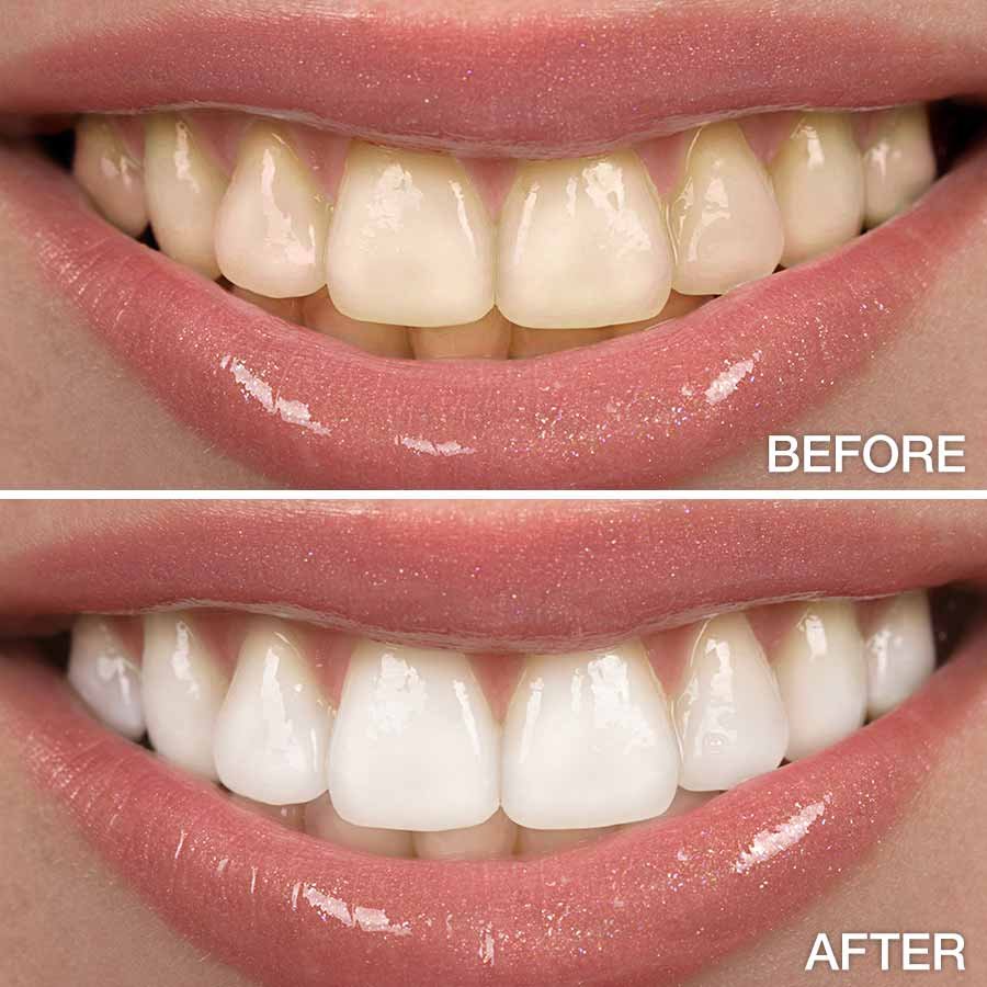 Before and after comparison of teeth whitening treatment showing noticeable improvement in tooth color and brightness.