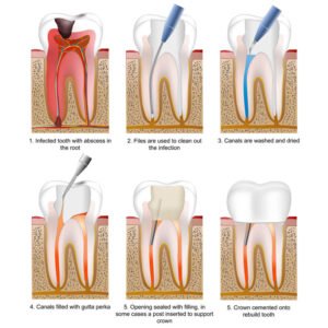 root canal treatment showing infected tooth, canal cleaning, disinfection, filling with gutta-percha, and crown placement.