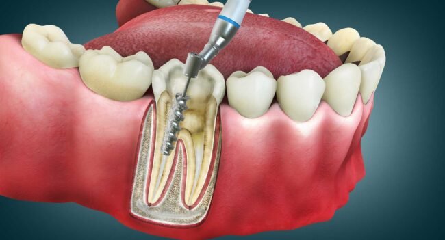 Dental root canal treatment illustration showing removal of infected pulp and placement of a dental post inside the tooth root.