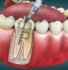 Dental root canal treatment illustration showing removal of infected pulp and placement of a dental post inside the tooth root.