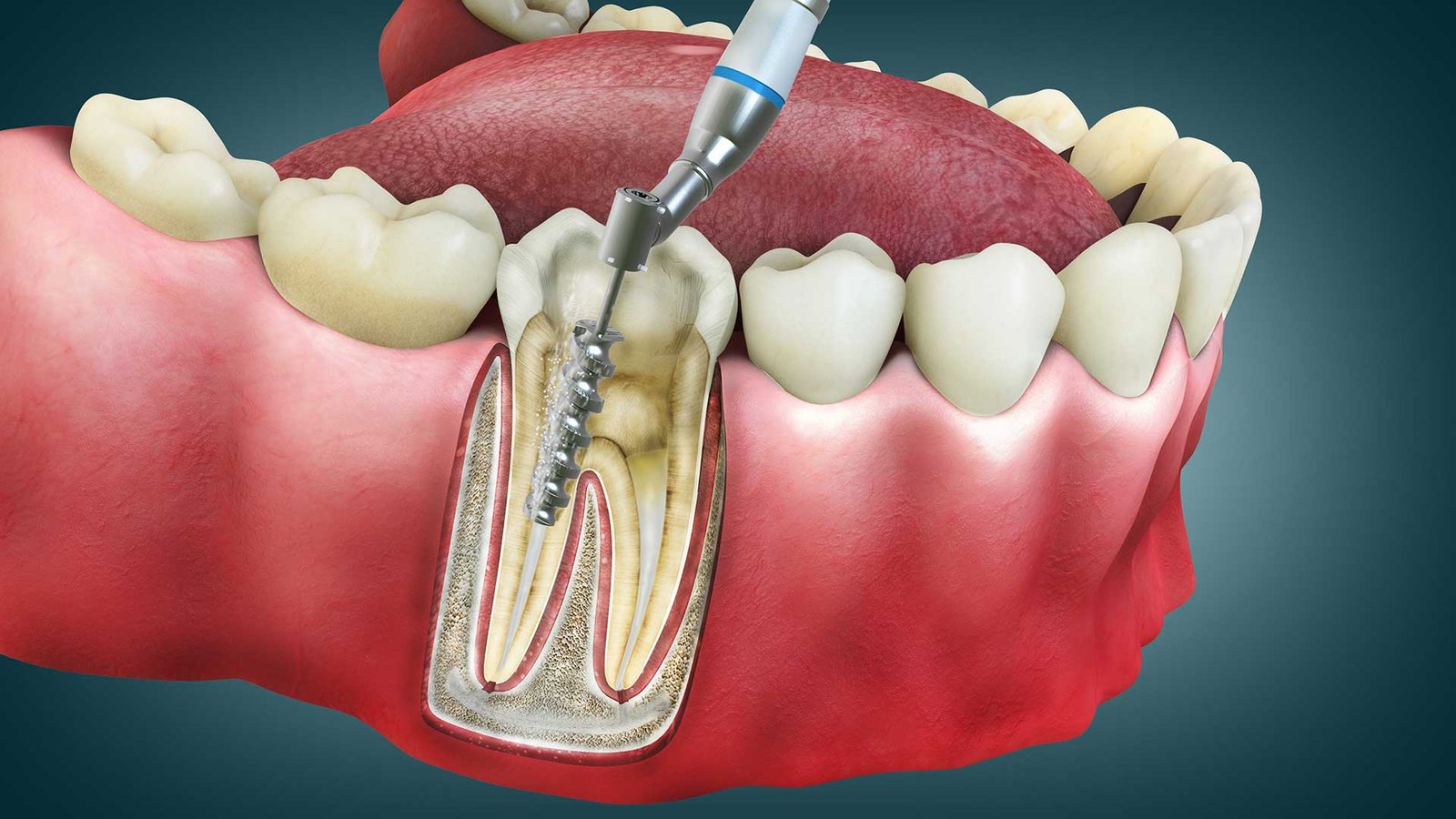 Dental root canal treatment illustration showing removal of infected pulp and placement of a dental post inside the tooth root.