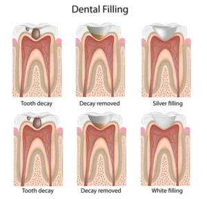 dental filling procedure steps including tooth decay, decay removal, silver filling, and white composite filling comparison.